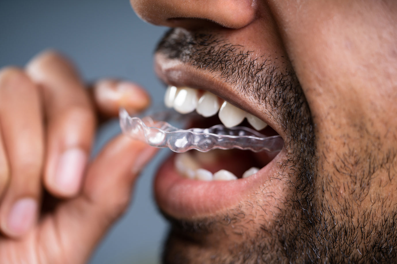 The Science Behind Clear Aligners: How They Move Your Teeth